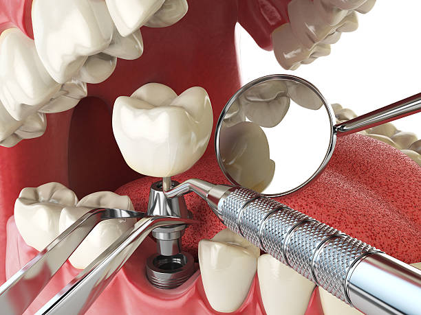 Best Emergency Tooth Extraction in Thunderbolt, GA